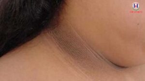 Dark Patches on Child’s Neck and Underarms Could Signal a Health Issue